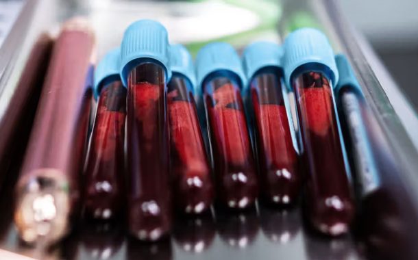 ছড়িয়ে পড়া স্তন ক্যানসার চিকিৎসায় ‘গেম-চেঞ্জার’ হতে পারে নতুন এক পরীক্ষা