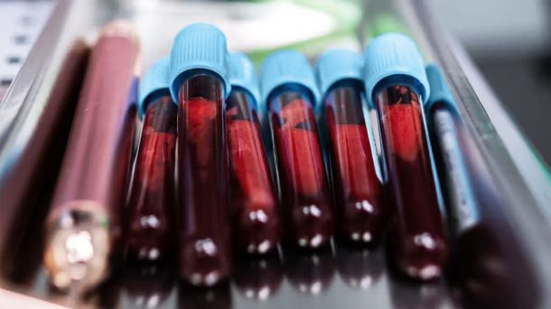 ছড়িয়ে পড়া স্তন ক্যানসার চিকিৎসায় ‘গেম-চেঞ্জার’ হতে পারে নতুন এক পরীক্ষা